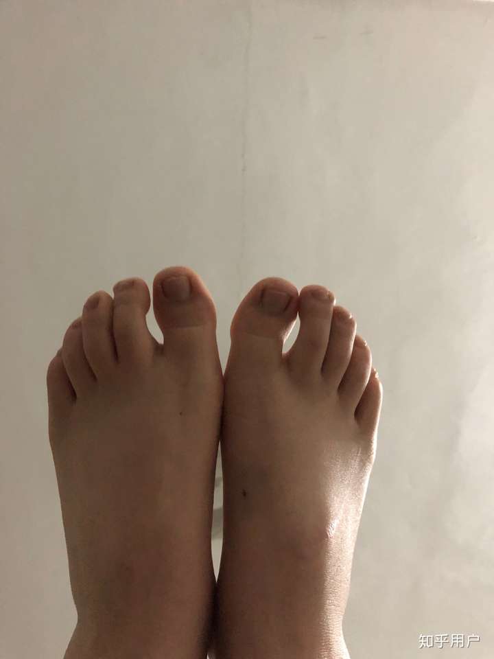 作为一个女生,脚拇指外翻是一种怎样的体验?