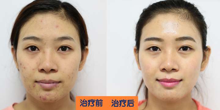 根,在配合彩光嫩肤,从深层激活肌肤胶原蛋白,修复受损肌肤,,达到祛痘