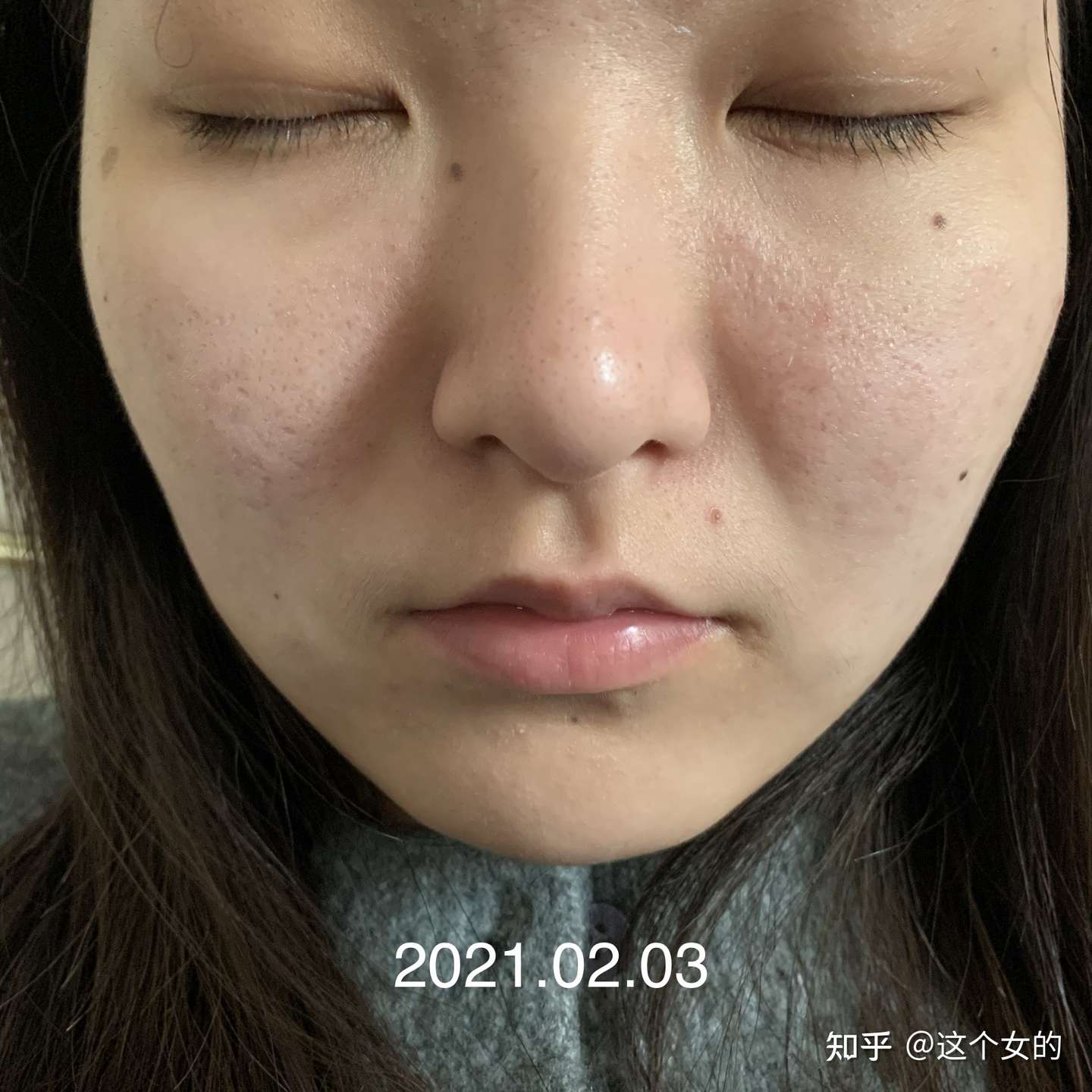 异维a酸停药半年多后复发 真正的勇士就是再吃一次 持续更新 知乎