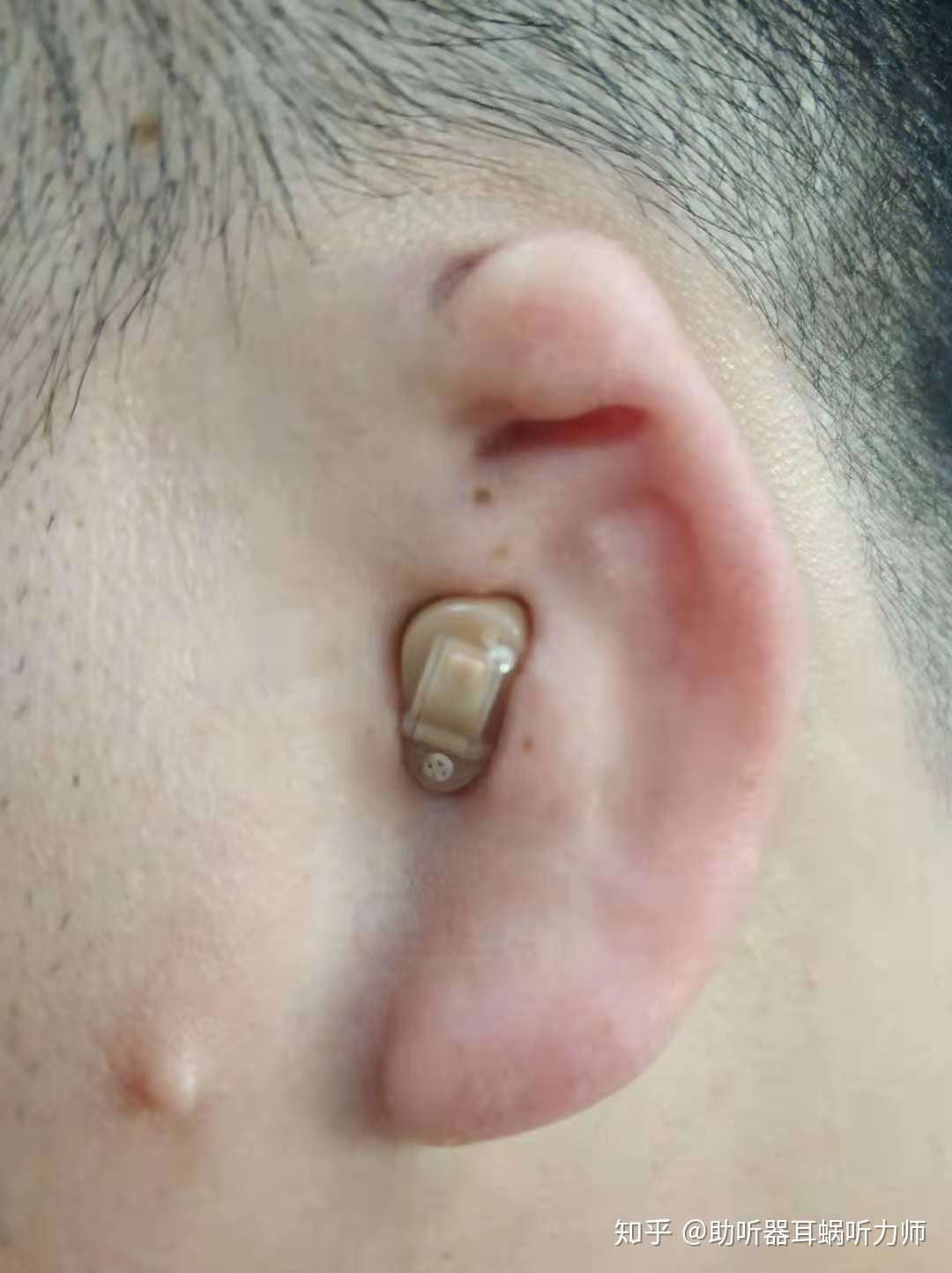 门诊的工程师为小耳畸形的用户,量身定制的不同功率的助听器,按听力
