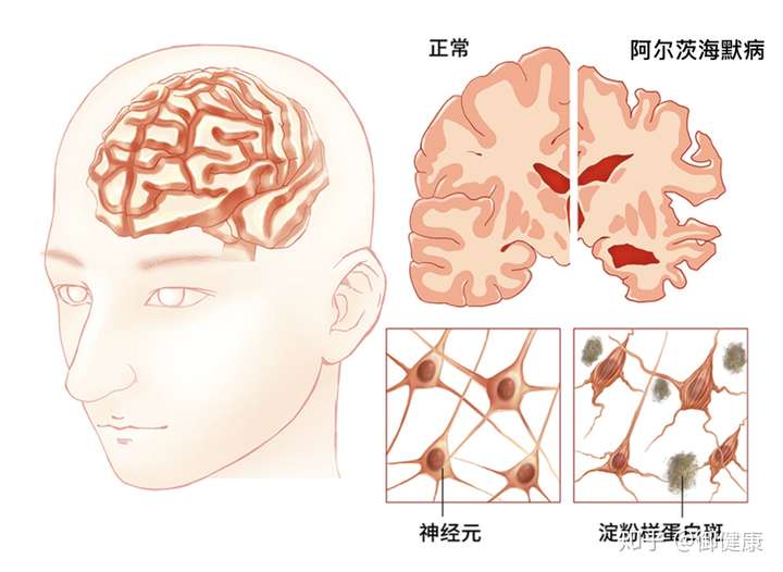 「阿尔茨海默症」是一种什么样的病症,有哪些病因与症状,该如何预防与