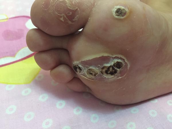 能看到大脚趾的黑色的,是烧过的根部,这几个比较浅,已经好了