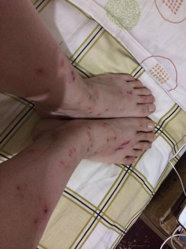 我觉得我快疯掉了,被咬成这个样子,这个点通宵不睡在床上逮跳蚤,用了