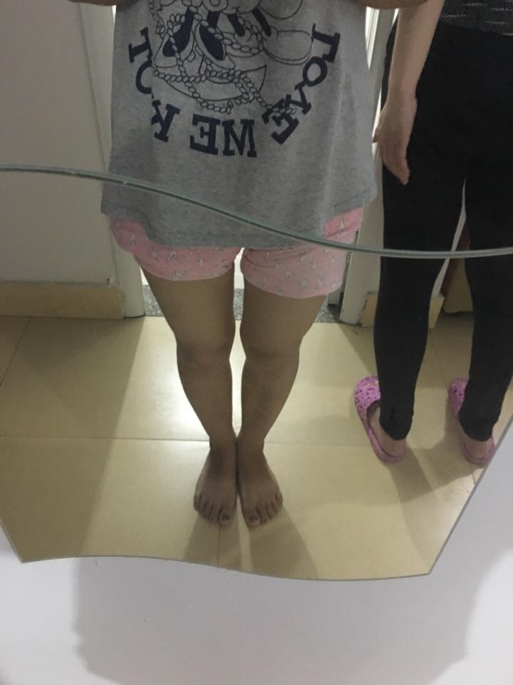 腿不直,小腿外翻怎么矫正?