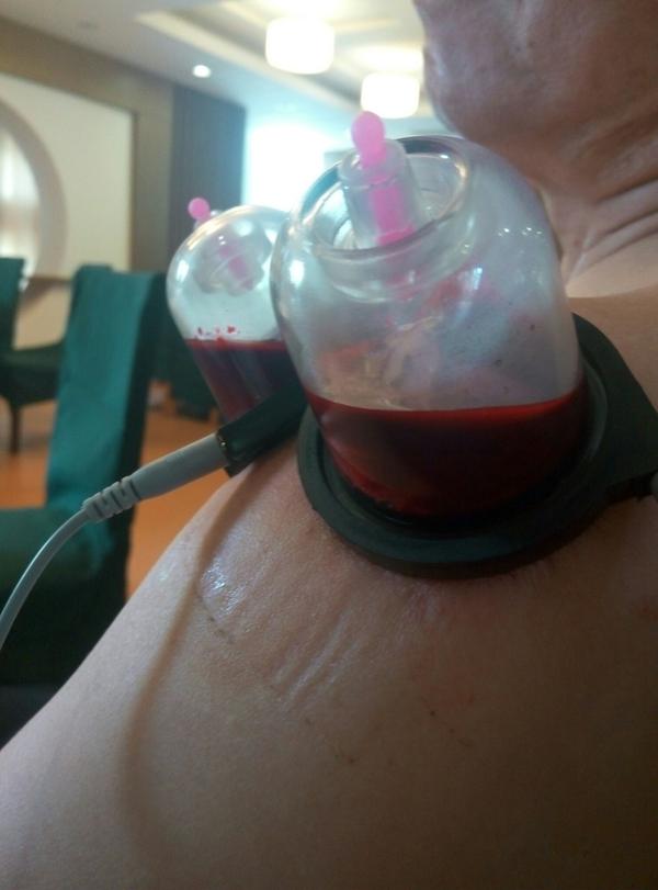 针灸放血的原理是什么?