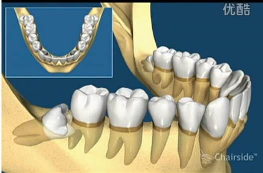 拔除智齿对脸型会有明显影响吗?