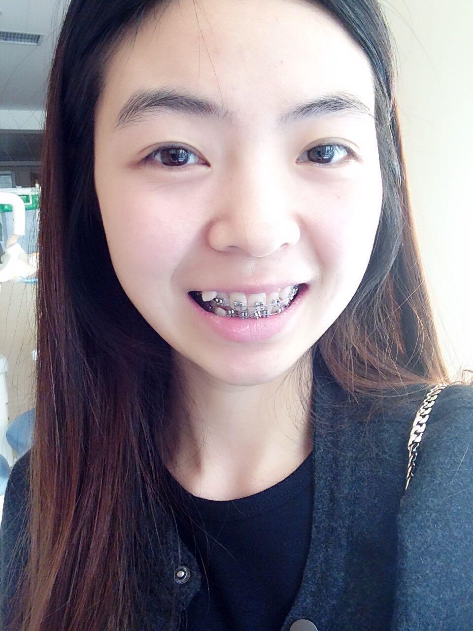 今天正式变钢牙妹了 医生最后决定收我一万二  显示全部