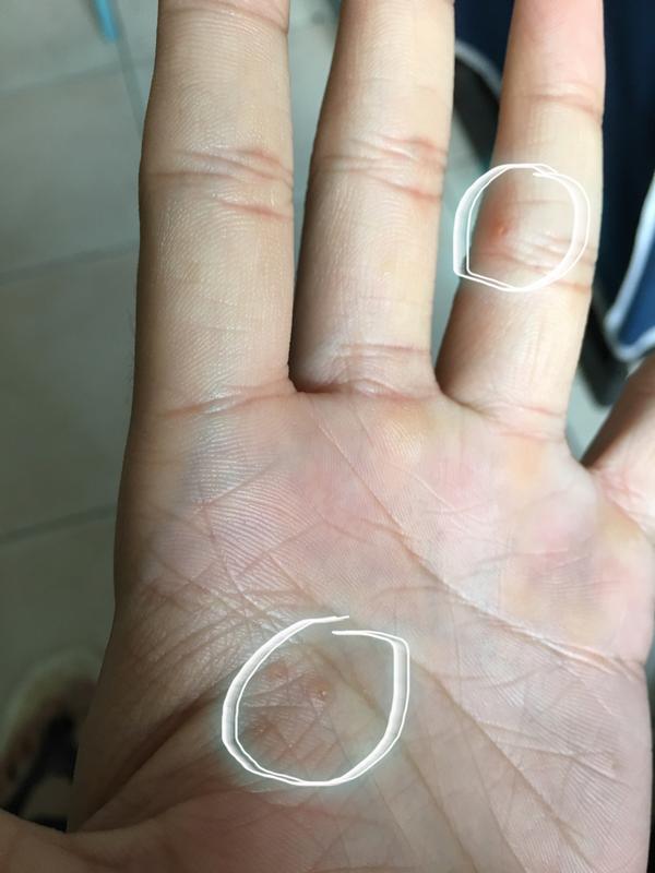 手上长很多类似水泡的东西,不痒且看起来不像