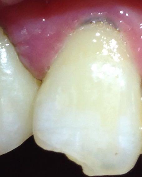 牙齿根部发黑是什么问题啊?
