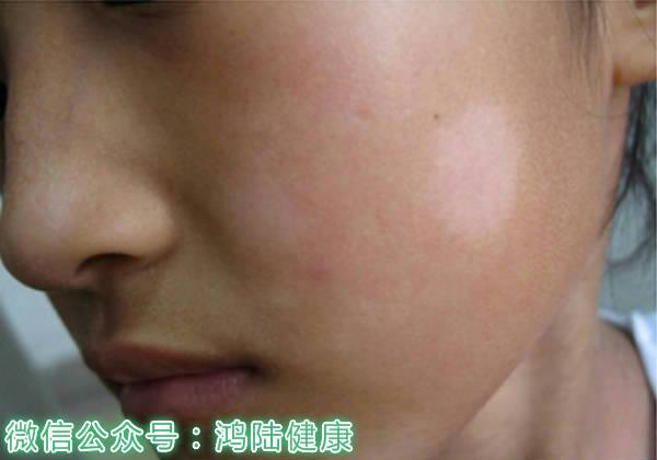 年龄层,且7,8月大热天是其好发季节,所以又有"脸上夏雪"或"白癣"之称