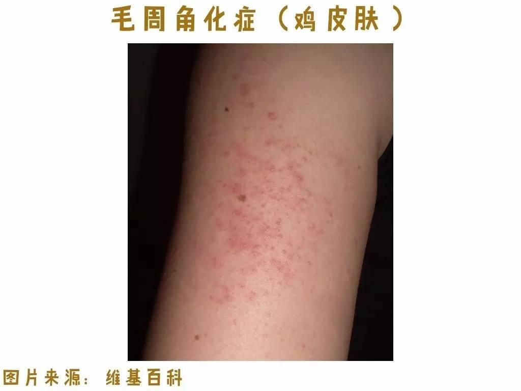 中医缓解鸡皮肤(民间秘方治疗鸡皮肤)