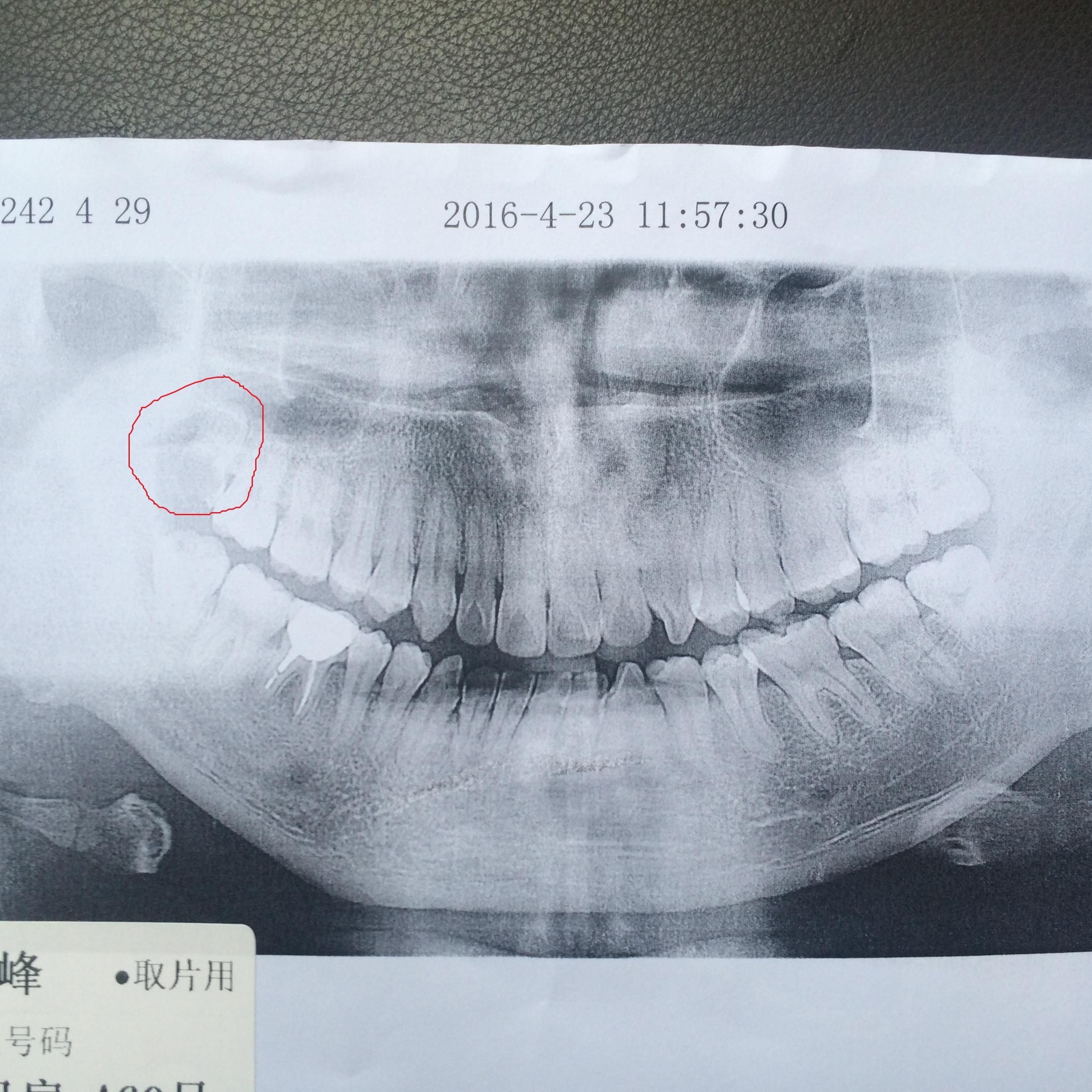 【附图】右上智齿蛀牙了,想拔掉,牙根貌似接近上颌窦,难度如何?
