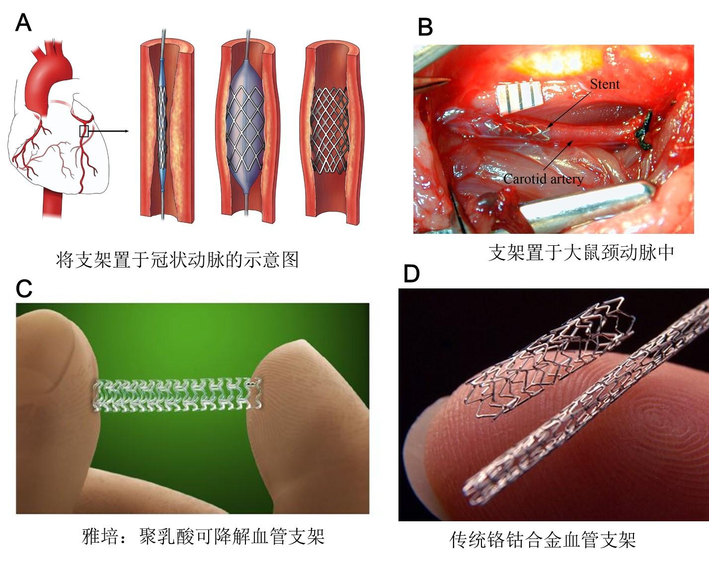 【病例分享】Minos®覆膜支架系统在上海市完成首例临床植入_患者