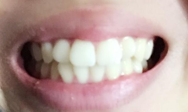 我是龅牙,医生说拔牙脸型改变还可能撇嘴,怎么