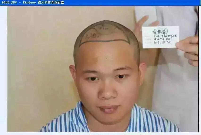 植发有害吗,为什么威廉王子脱发挺厉害的,却没