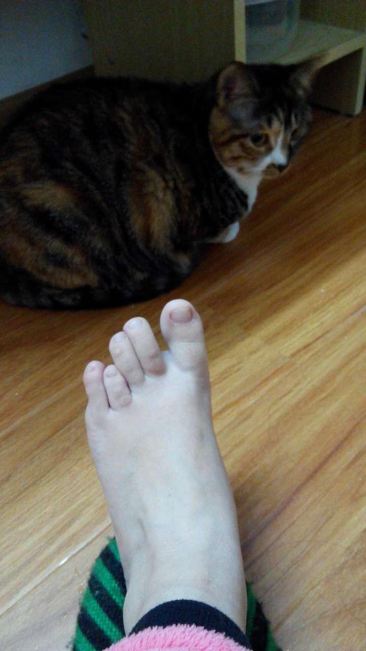 关于第四脚趾短小症的困惑
