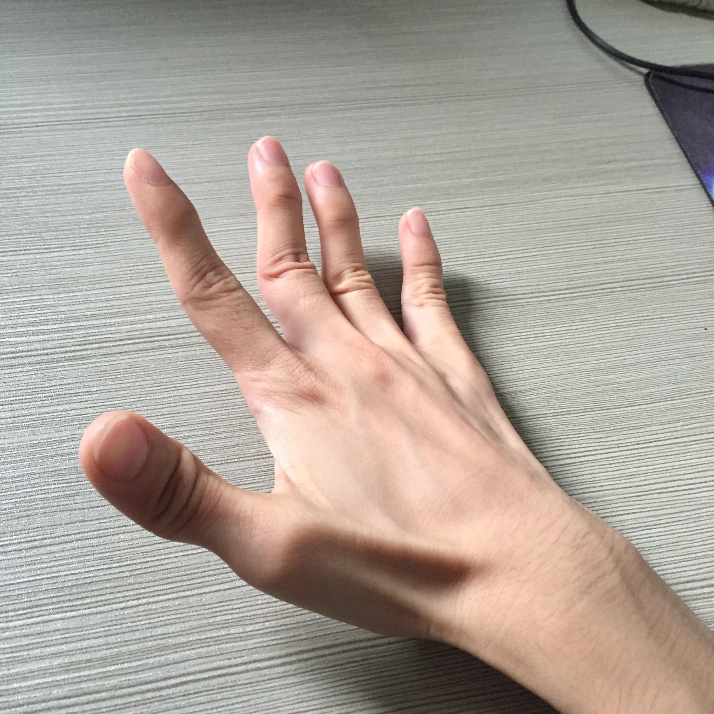 手指彎曲是什麼原因造成的？ - GetIt01