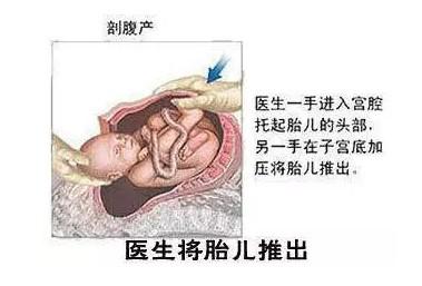 图解揭秘:剖宫产手术全过程