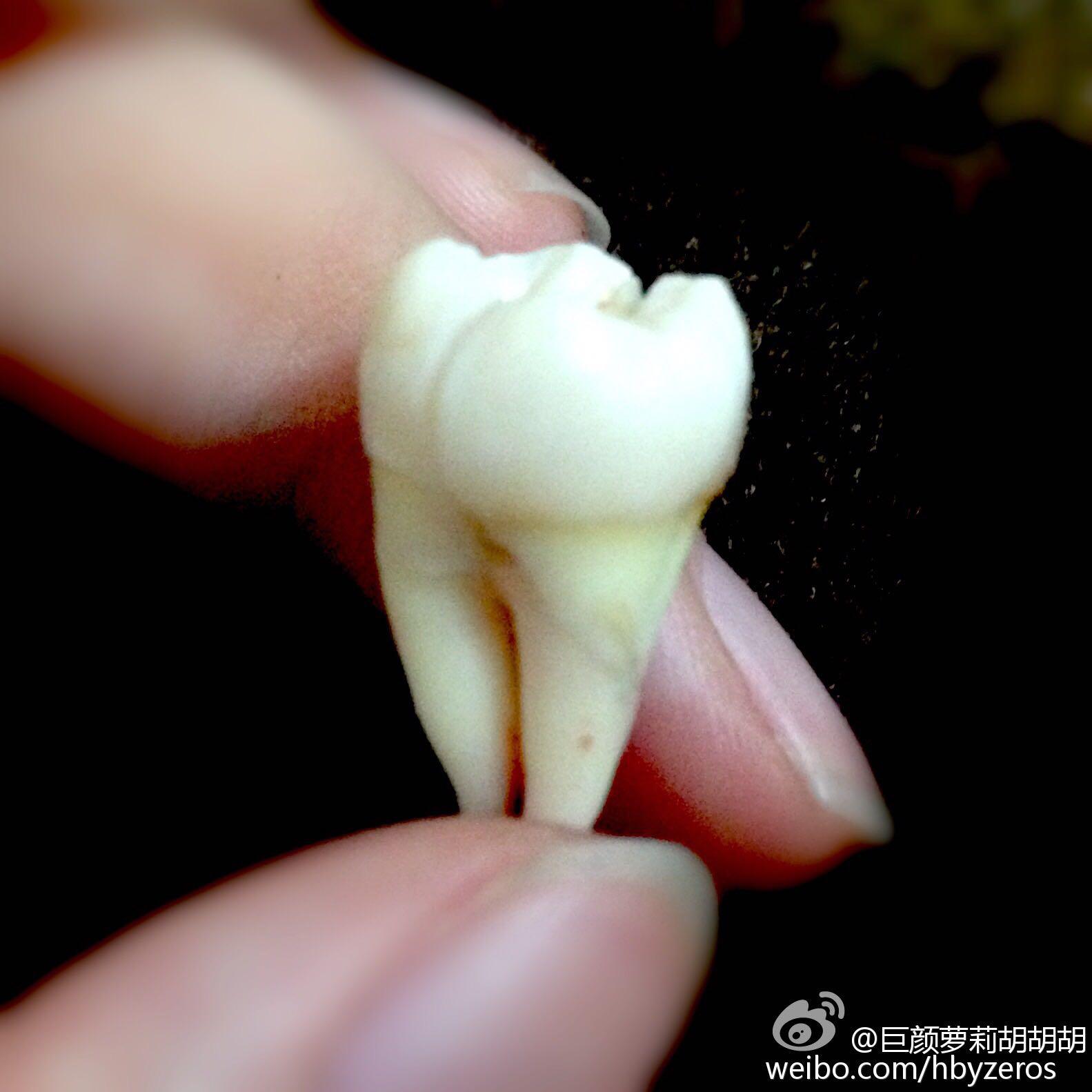 骨性嘴凸，牙齿矫正，上海口腔病防治院