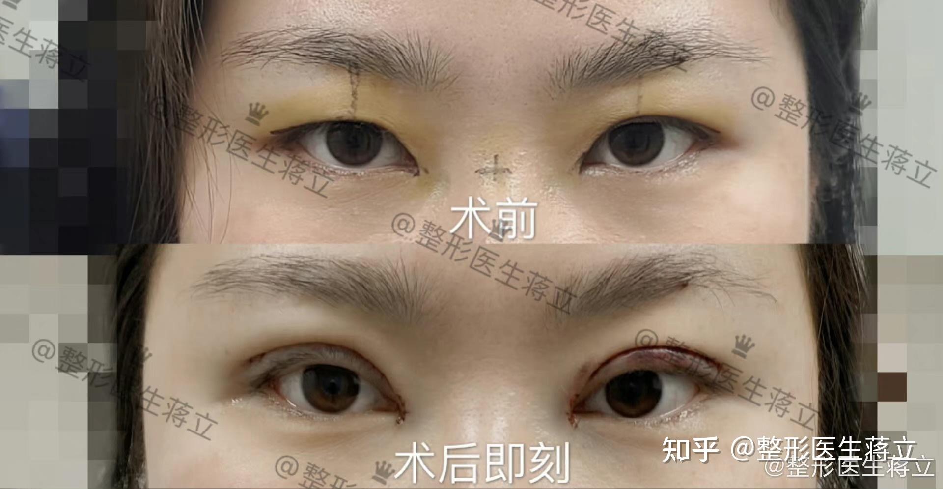 尤美案例之最真实的双眼皮手术记录 - 知乎