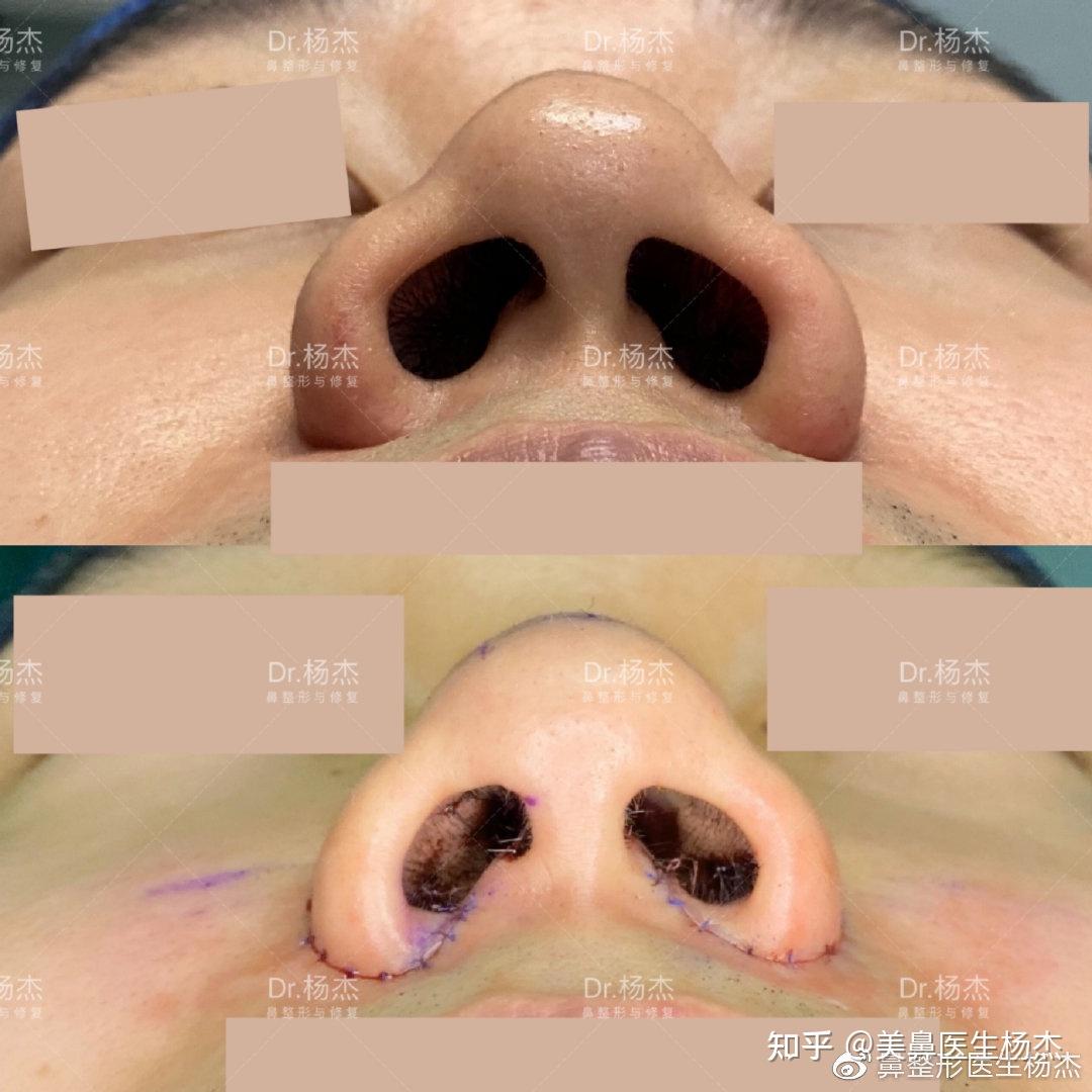 鼻翼缩小术后反弹解析