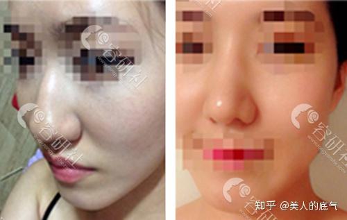 歪鼻该如何矫正 韩国纯真崔宰源mesh假体隆鼻风格 效果大揭秘 知乎