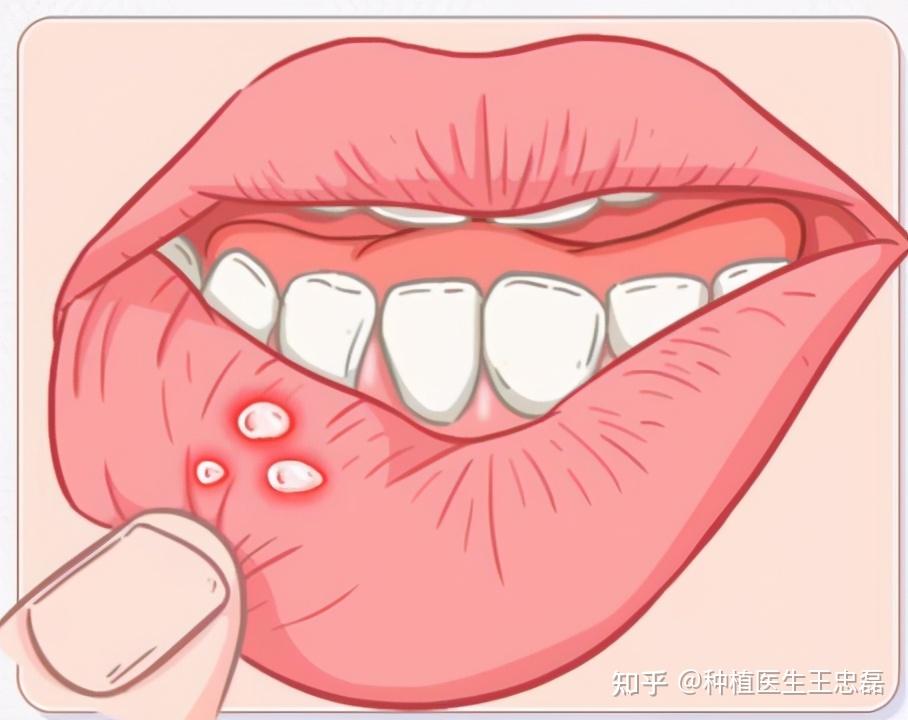 口腔溃疡长时间不愈有病变成口腔癌的风险要注意预防