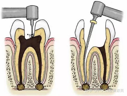 原因一:自然生理变化随着年龄的增长,根管系统内会有一些钙化物质的