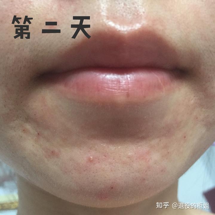 刷酸后为什么会返黑? - 知乎