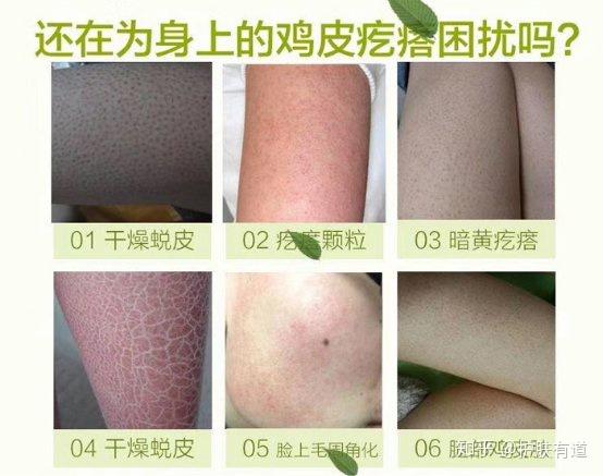 网上卖的去鸡皮肤的有用吗(淘宝上买的去鸡皮肤的产品好不好)