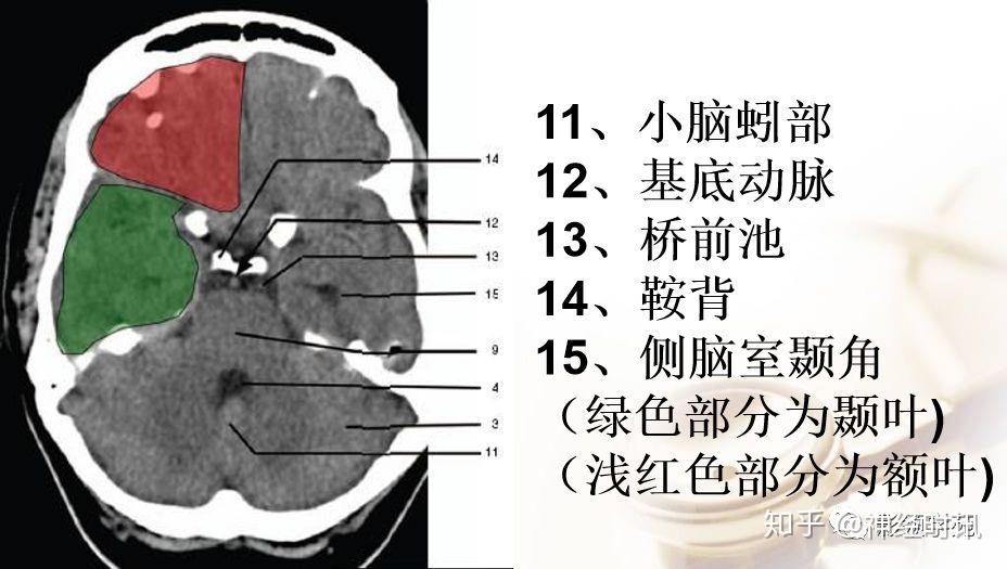 解剖影像腦實質ct斷層解剖