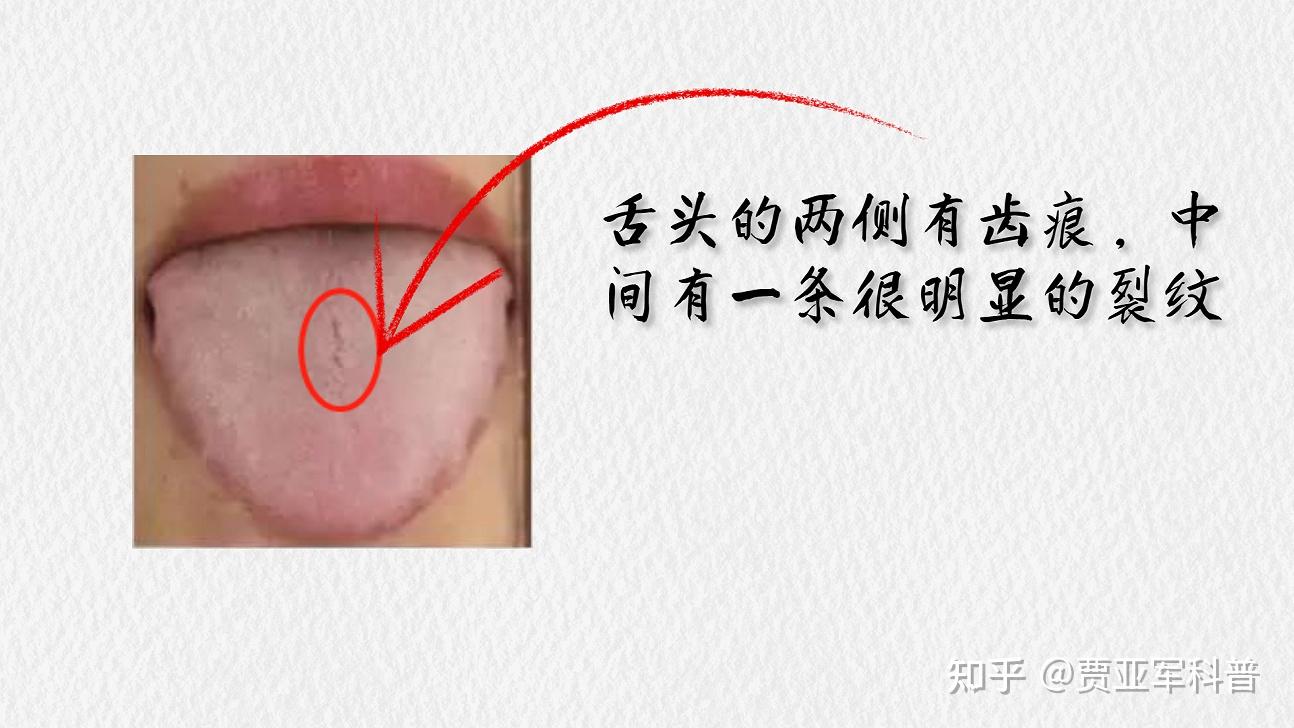 气虚怎么补?舌象告诉你答案,医生教你如何正确调理五脏气虚 - 知乎