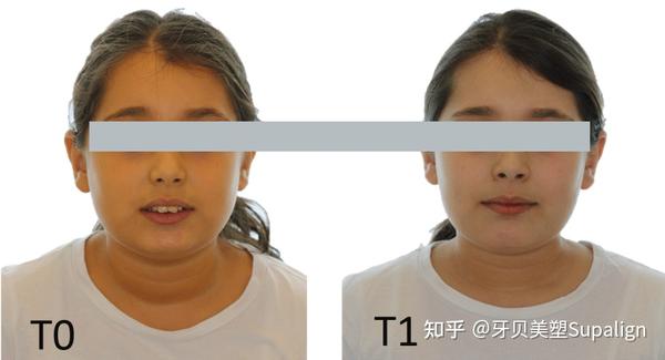 敲黑板!孩子嘴唇闭不拢这个问题是时候重视一下了~ - 知乎
