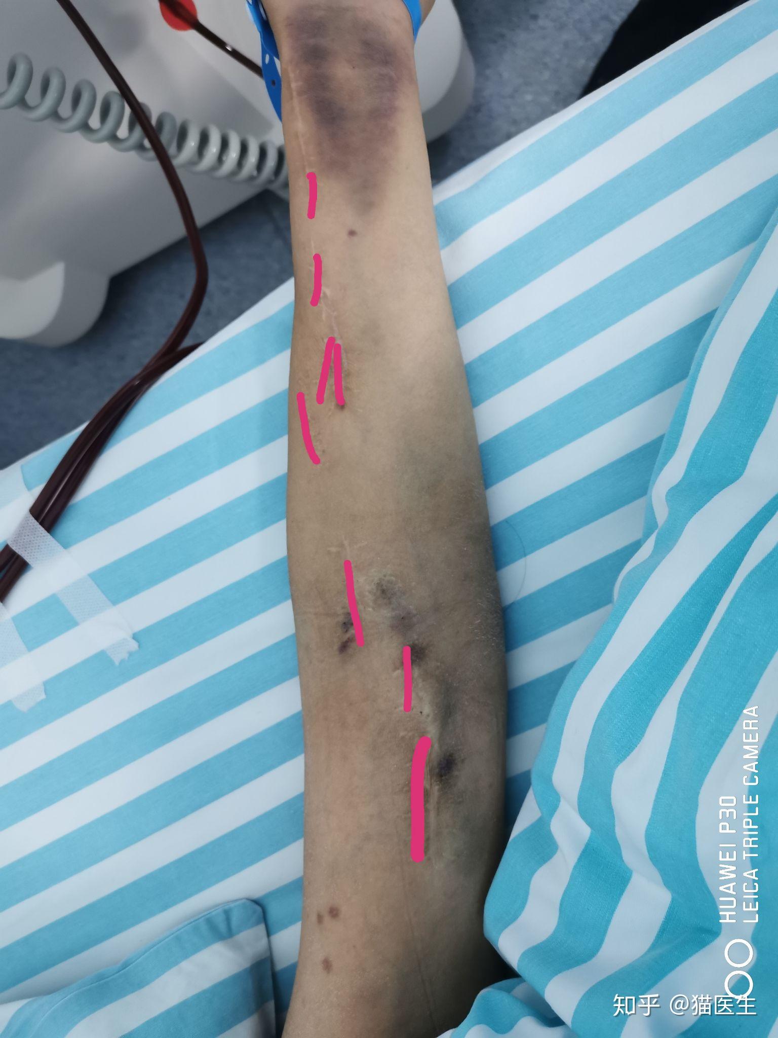 透析患者的手臂图图片