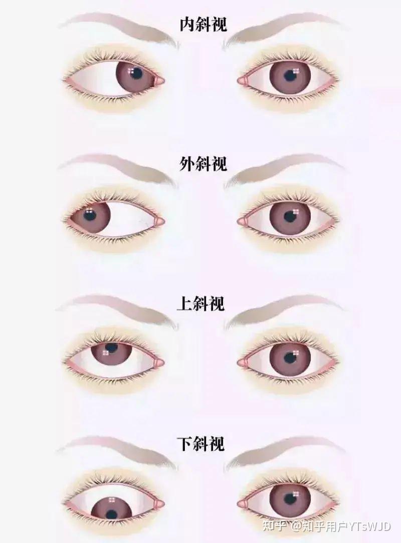 【眼健康科普课堂】坐教室侧面会导致孩子斜视？！ - 知乎