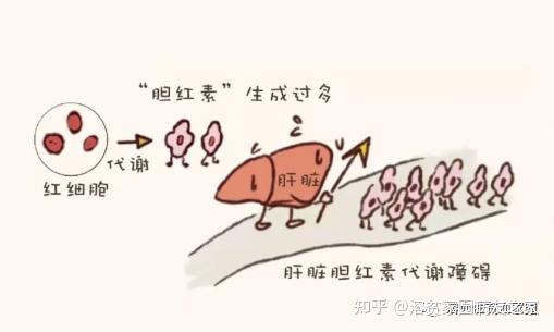 科普时间 | 溶血性贫血，怎么去黄？ - 知乎