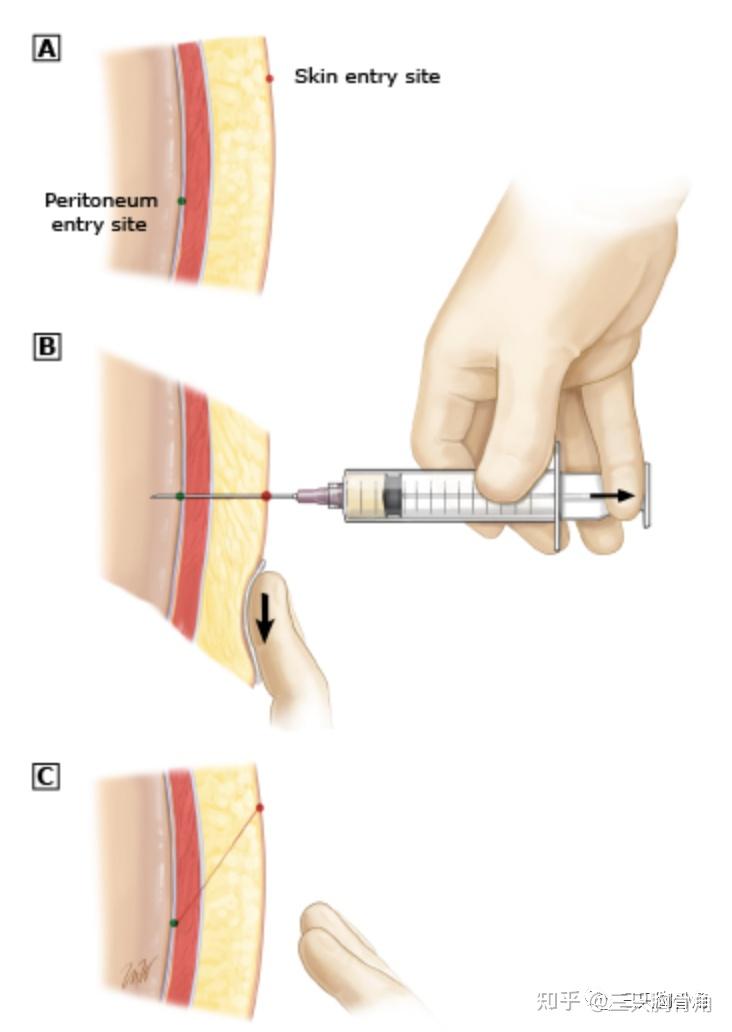 腹腔穿刺术进针图片