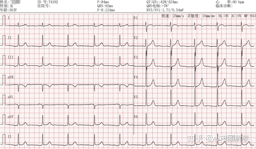 窦房结心电图特征图片