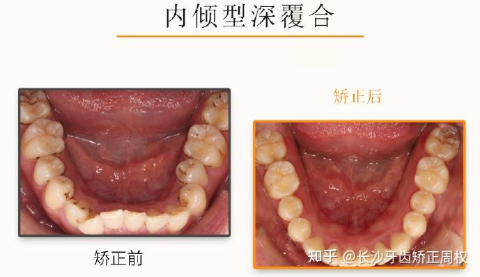 长沙牙齿矫正内倾型深覆合案例