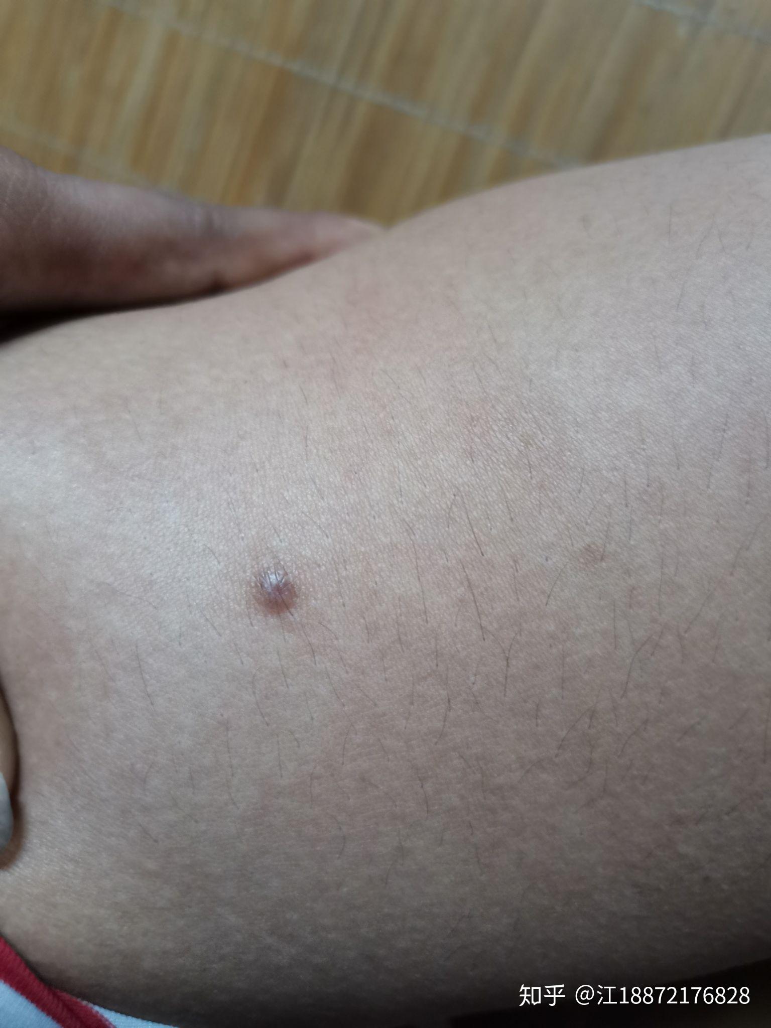 黑痣, - 知乎