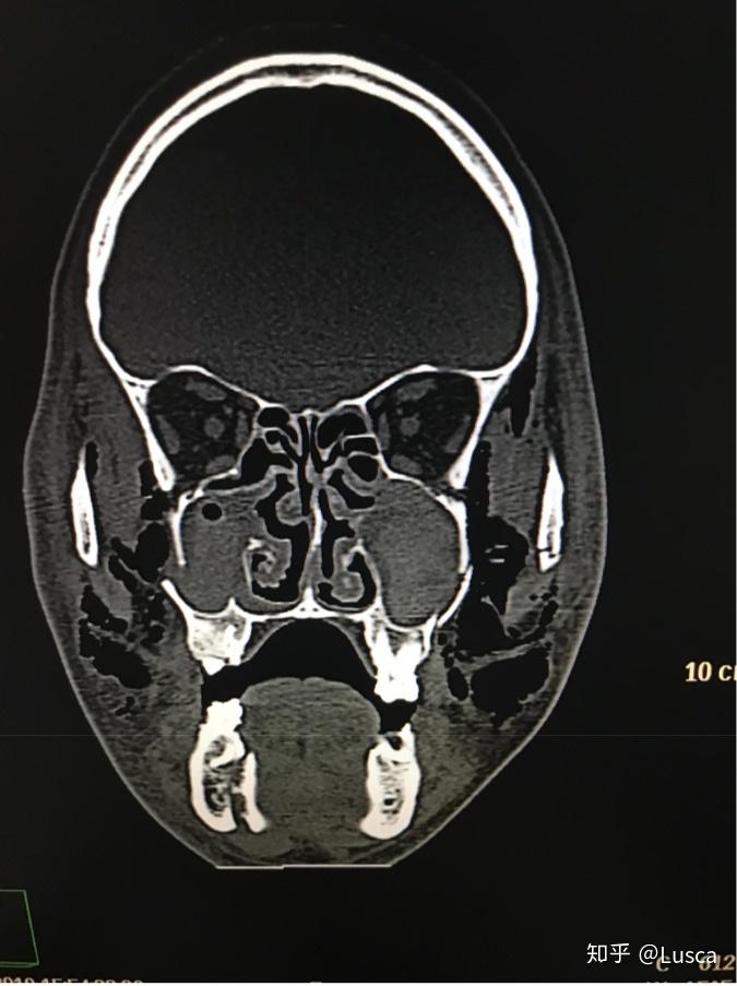 严重的颅面部骨折lefort骨折
