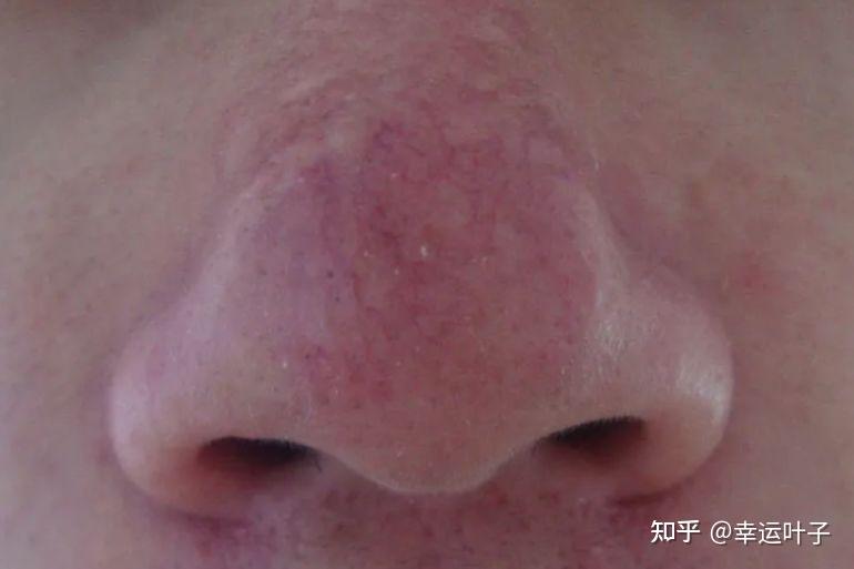 酒糟鼻鼻赘期要做这几件事切勿疏忽