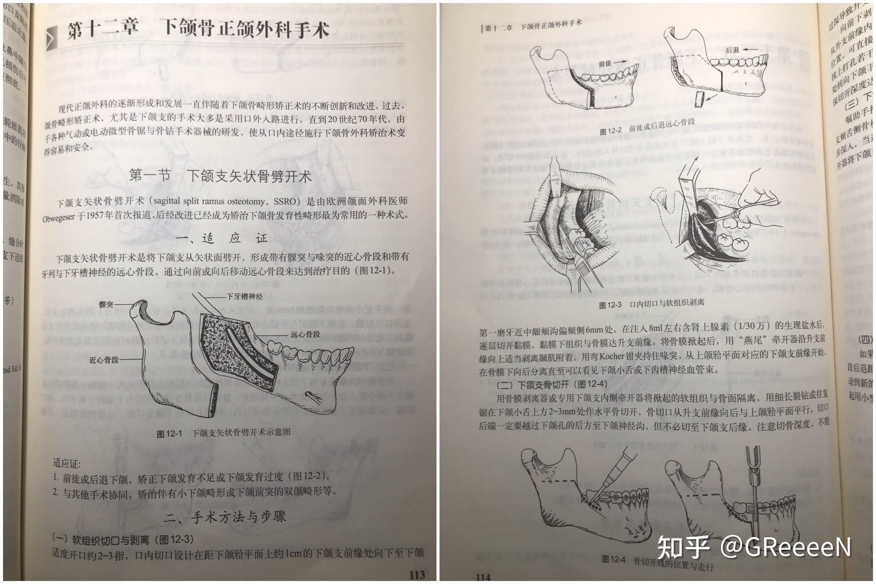 做正颌手术是怎样的体验?(更新21.11.30.文字内容)