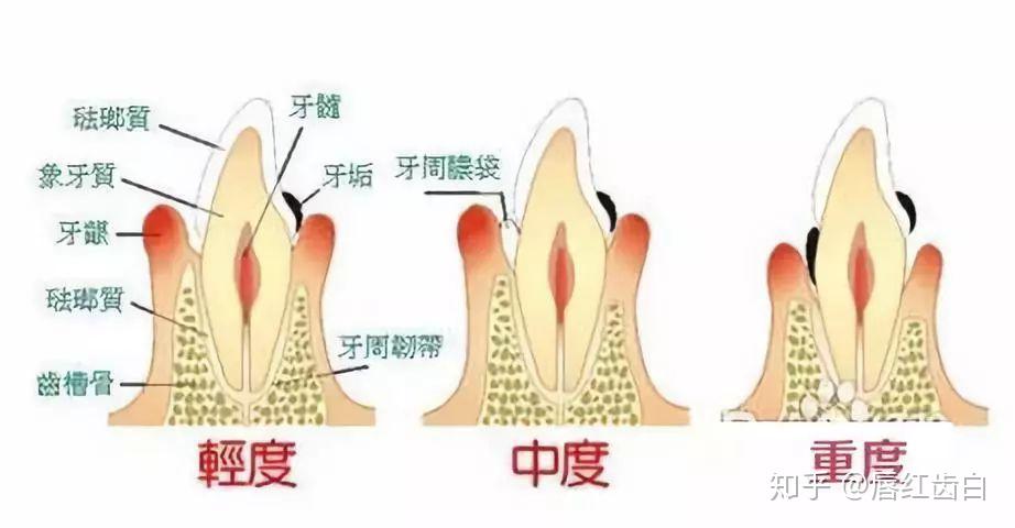 治疗不能解决全部问题,需要通过手术的方法对牙周软,硬组织进行处理