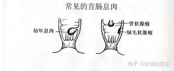 直肠肿瘤有良性的吗?