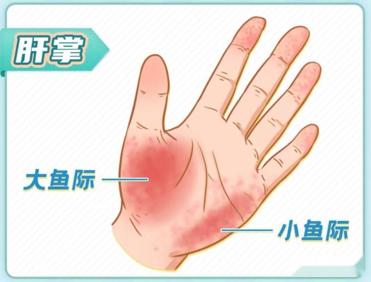 体内有癌,手指先知?注意:手指出现这些症状,可能是疾病的信号 - 知乎