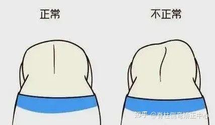 重磅 | 央视专题报道:我国中小学生脊柱侧弯人数已超500万! - 知乎