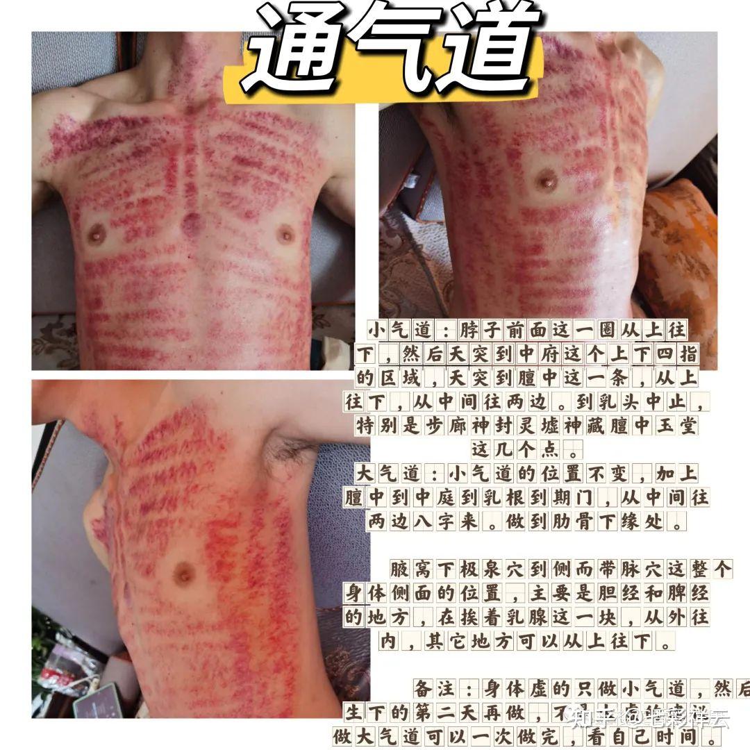 常见疾病刮痧方案总结含人体反射图，刮痧禁忌和痧像，痧味诊断疾病 - 知乎