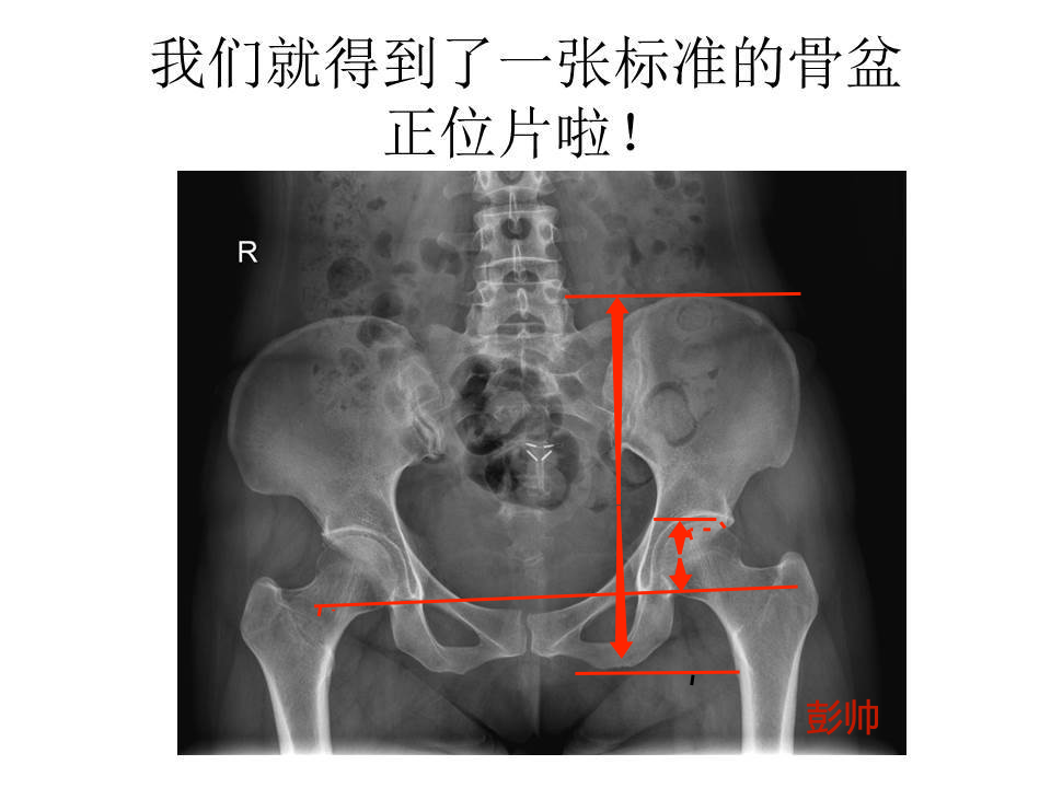 183先髋髋臼发育不良如何分型揭开它的神秘面纱