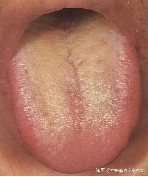 白苔:体内有寒湿,脾胃多半有湿气;黄苔:体内有热.